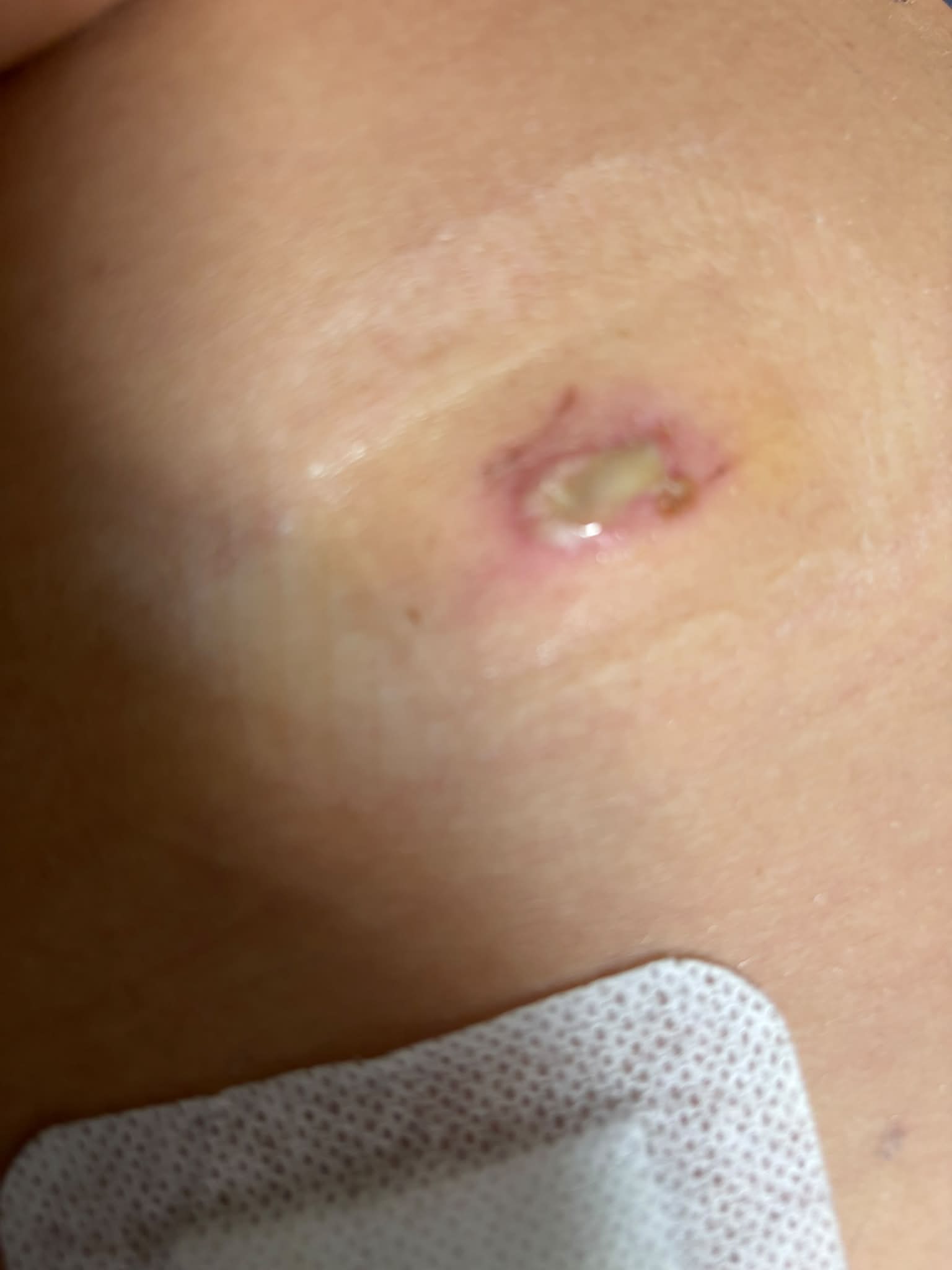 Has anyone used semaglutide or mounjaro after gallbladder removal? I'm nearly 4 weeks post op and wondering if it's safe to use now. Thankyou