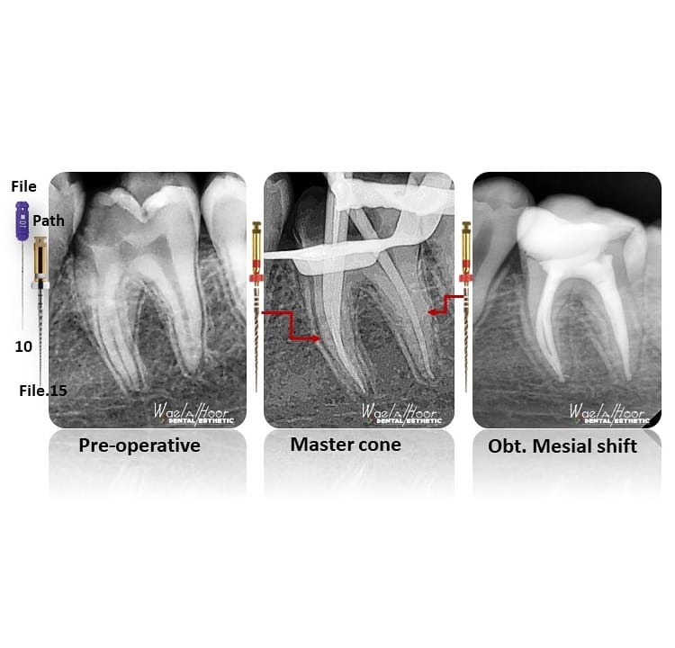 Endodontics | RCT FOR 36 | Facebook