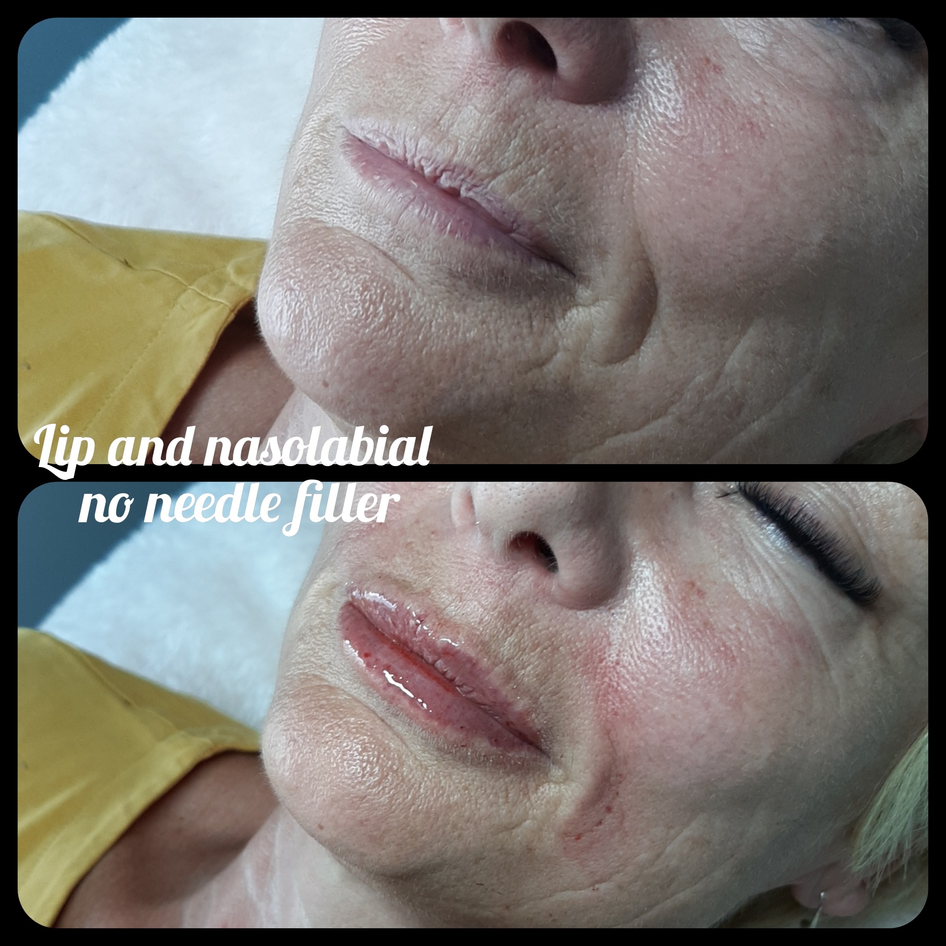 Infinity - 💋 No Needle Filler by Stevie 💋 🌟Appointments... | Facebook