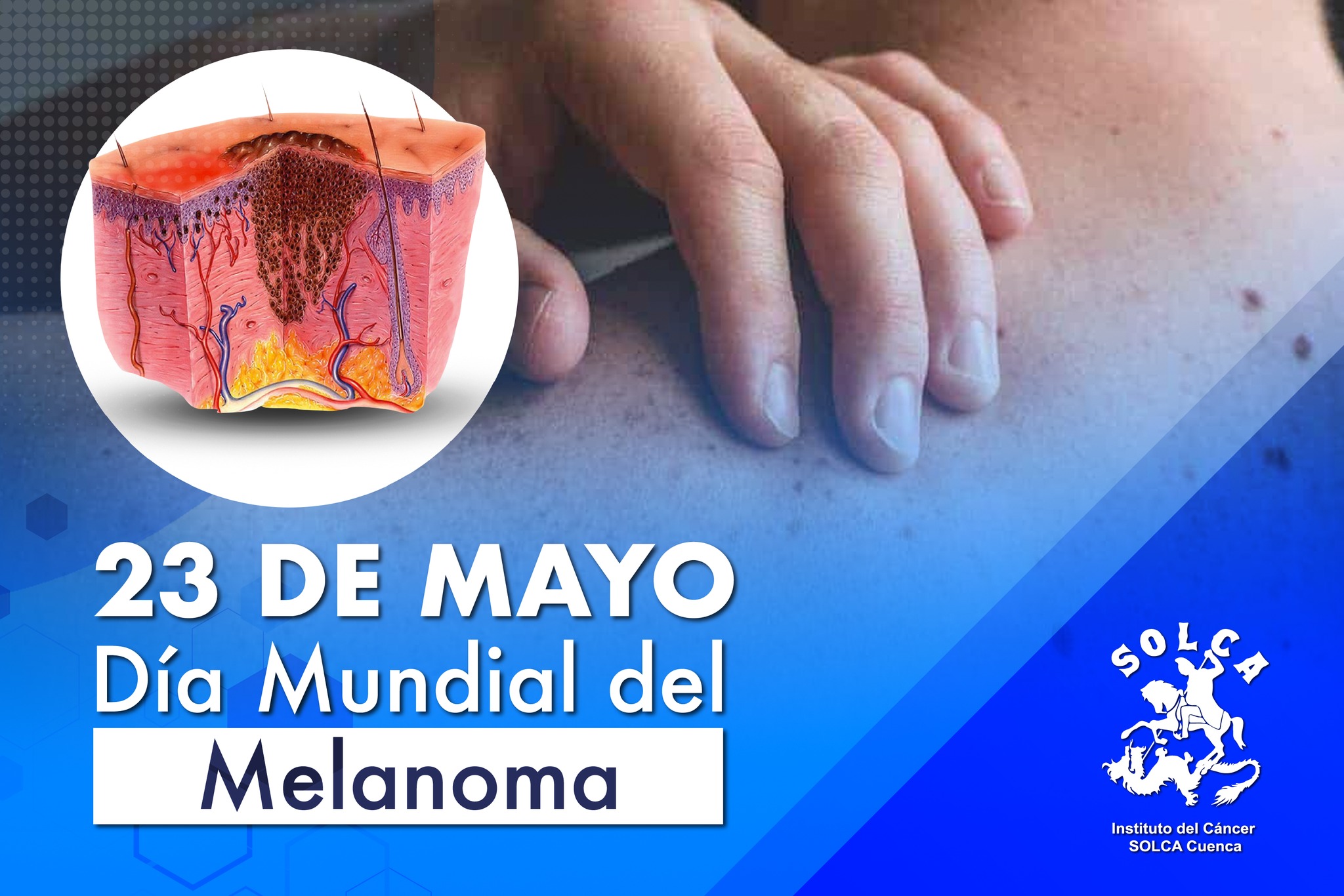 Cuidar tu salud... - Instituto del Cáncer SOLCA Cuenca