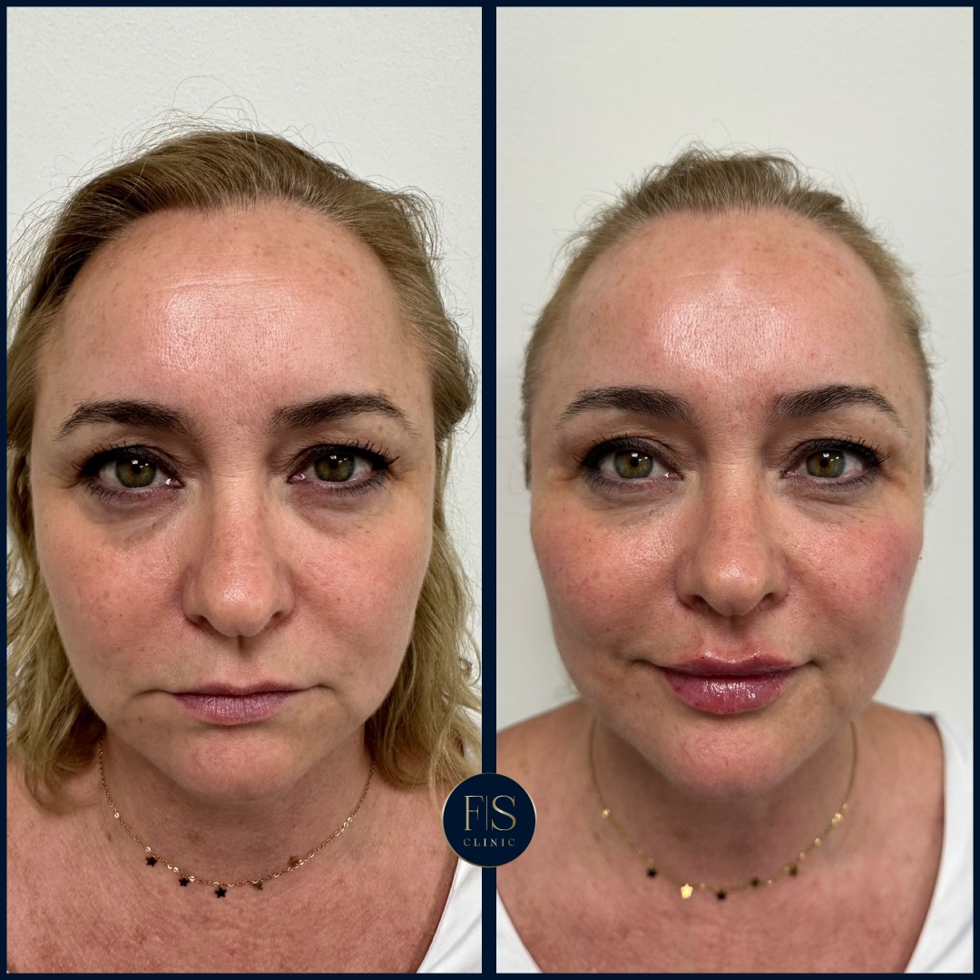 FS Clinic - ⭐ FULL FACE ⭐ Este es un gran ejemplo de lo...