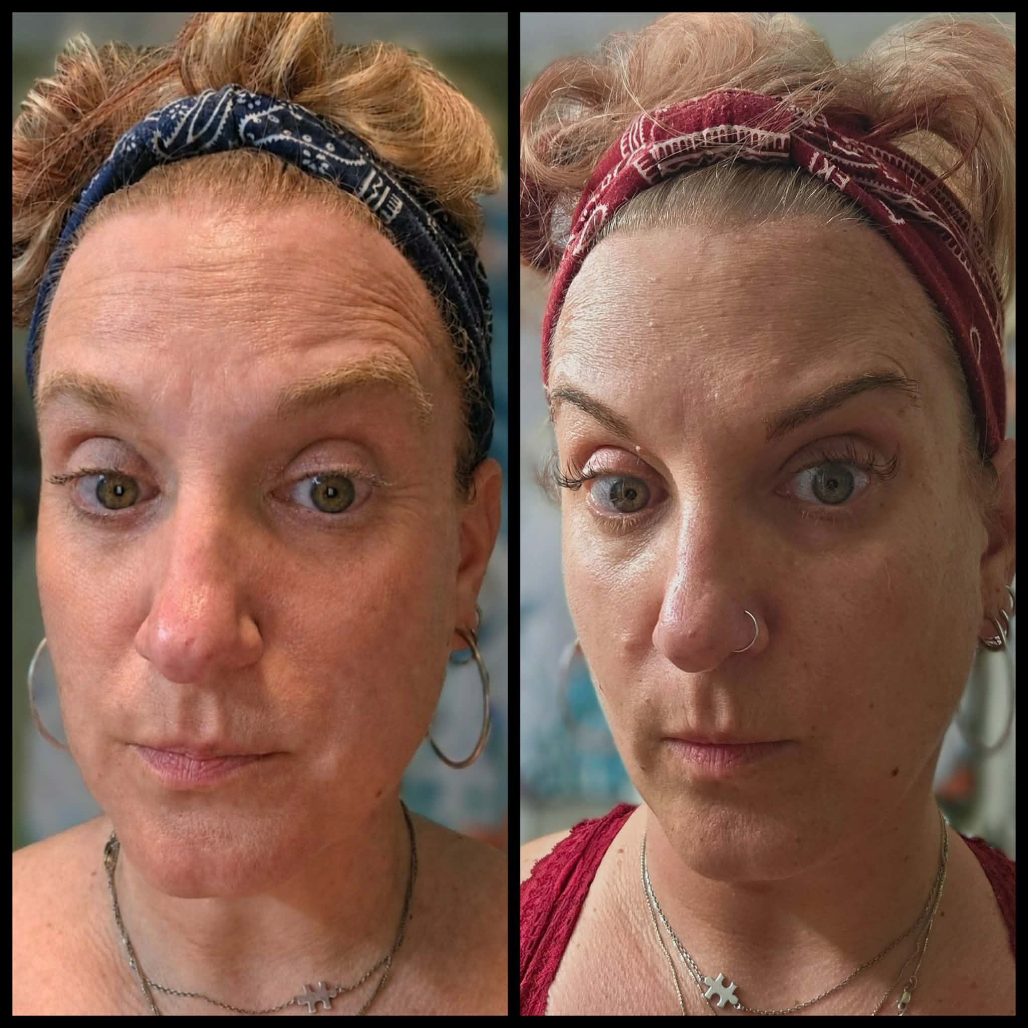 ghk cu side before and after Meet GHK-Cu, the Copper Peptide Taking Over Your Skincare Feed—Here's Whether It's Worth the Hype Peptides for Fat Loss: