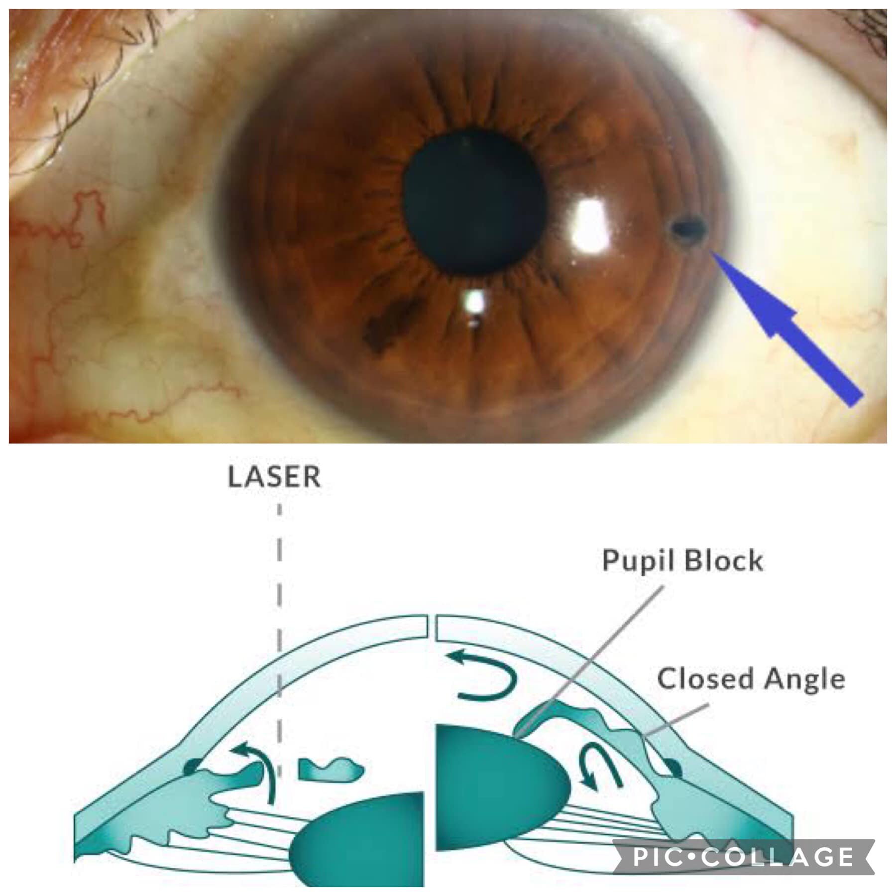 This is called a... - First Choice Eye and Vision Clinic