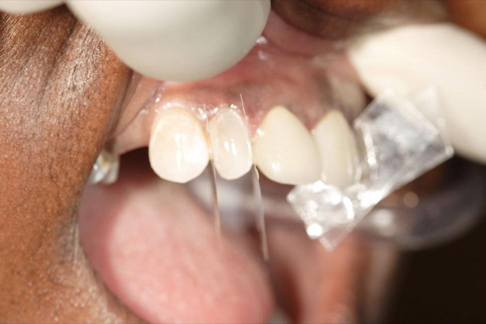 Cerinate One-hour Permanent Veneers | Facebook