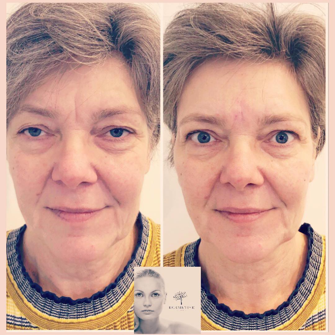 ⭐️Full face behandling med ialt 3... - Kosmetisk Hviidsminde
