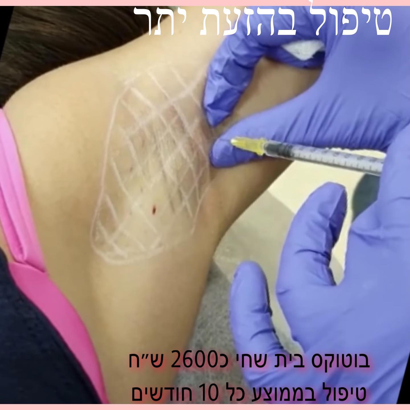 Dr.Begelman Lina - הטיפול לוקח כמה דקות . זאת על ידי הזרקה של תרופה בשם ...