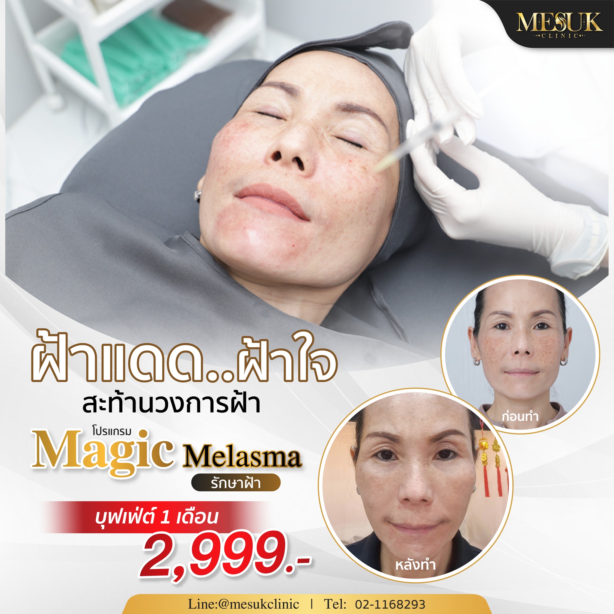 ฝ้าแดด ฝ้าใจ สะท้านวงการฝ้า โปรแกรม Magic melasma รักษาฝ้า อันตรายแดด ...