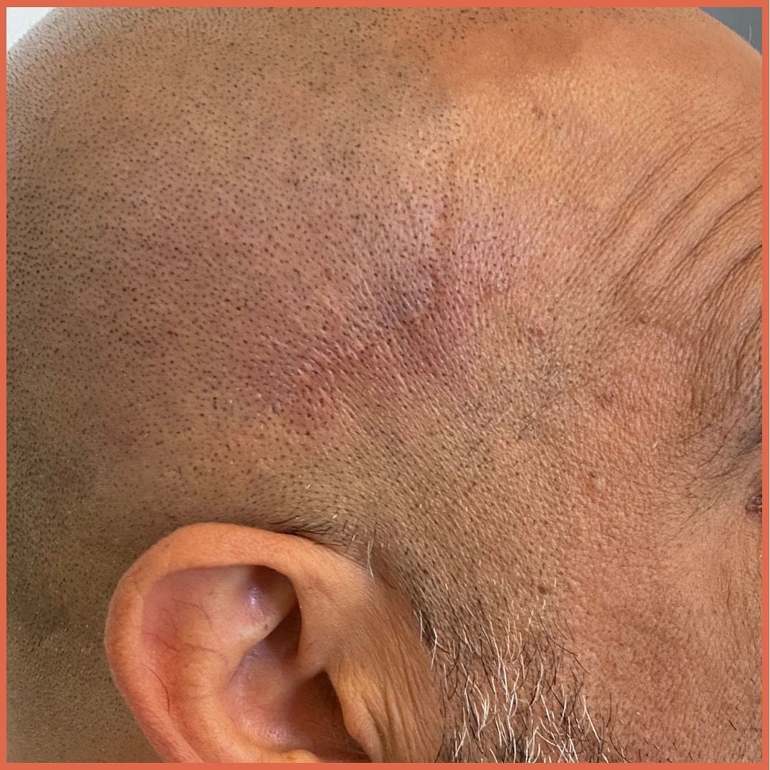 Confidence Ink - Did you know Scalp Micropigmentation is...