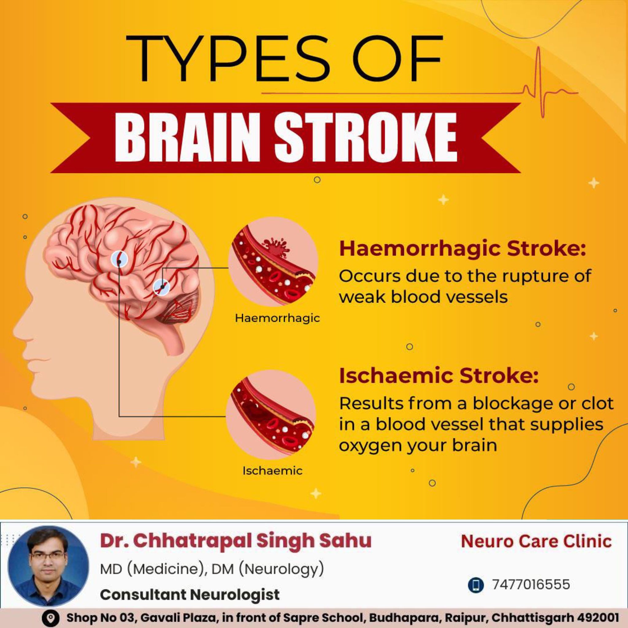 Neuro - Types of brain strokes include ischemic strokes (clot-related ...