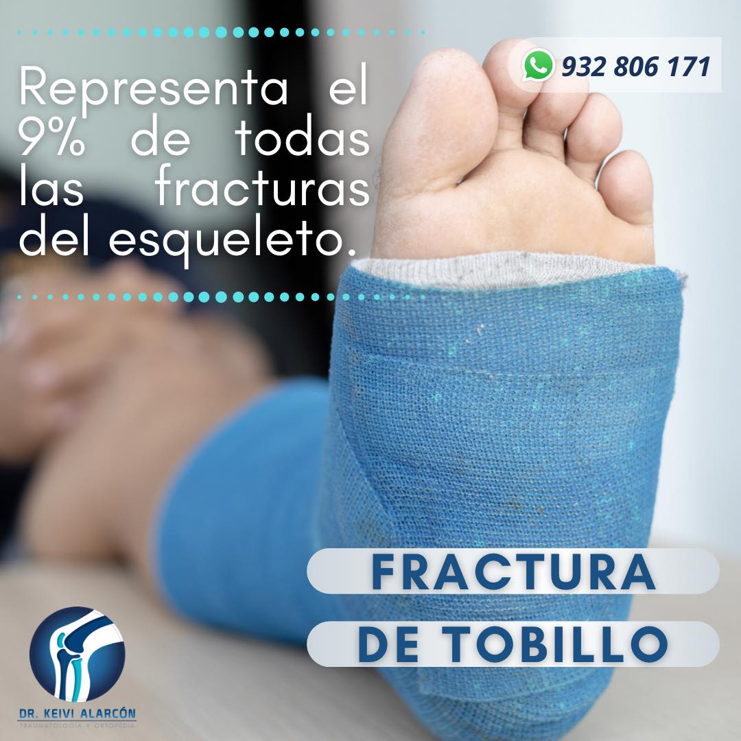 🚨Un tobillo roto o... - Dr. Keivi Alarcón - Traumatólogo