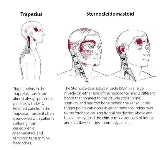 Texas - A trigger point or a muscle knot as it is often termed is an ...
