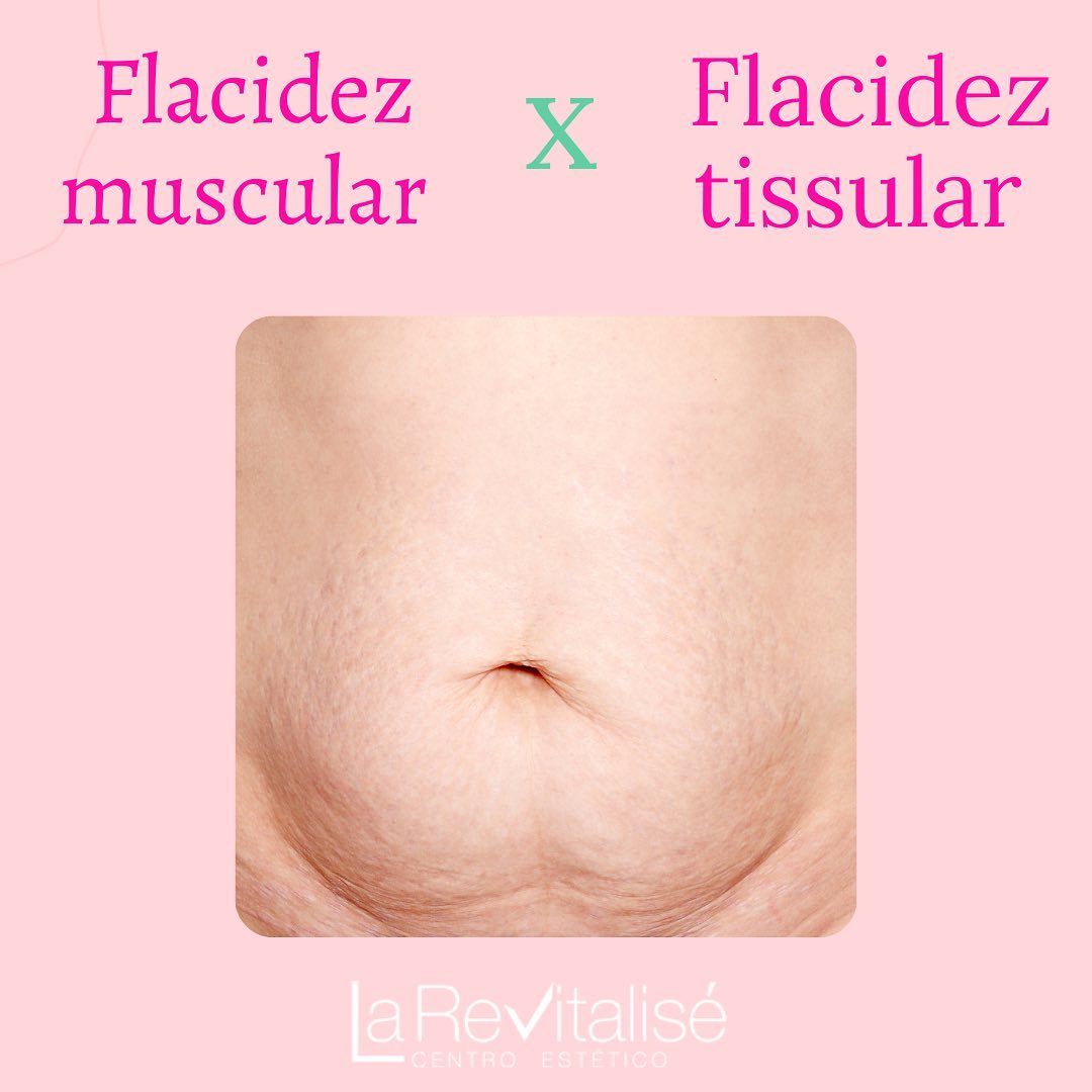 Dra Eliete Thiesen - Flacidez tissular nada mais é que a flacidez de ...