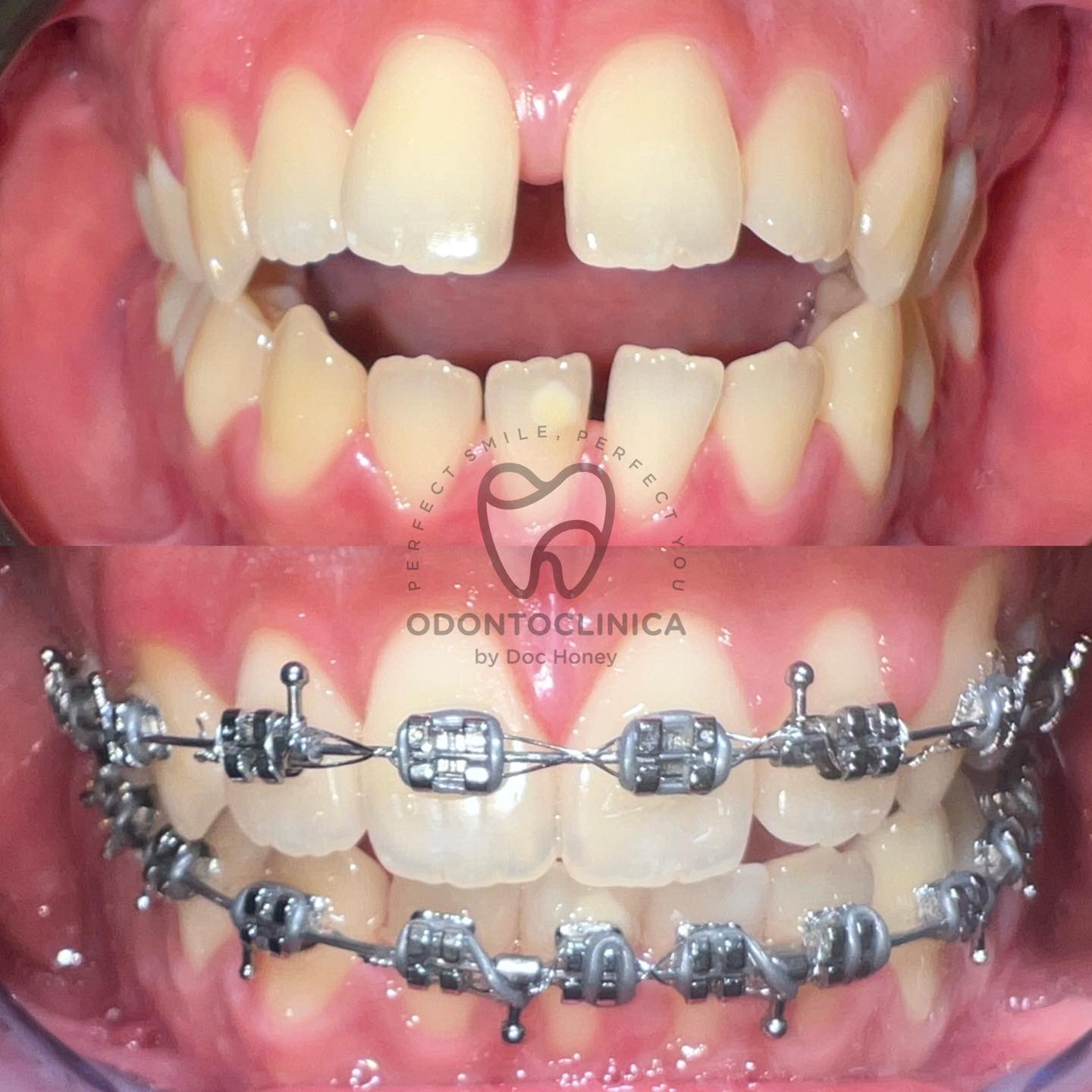 Anterior openbite (Pre-Op vs... - Odontoclinica by Doc Honey | Facebook