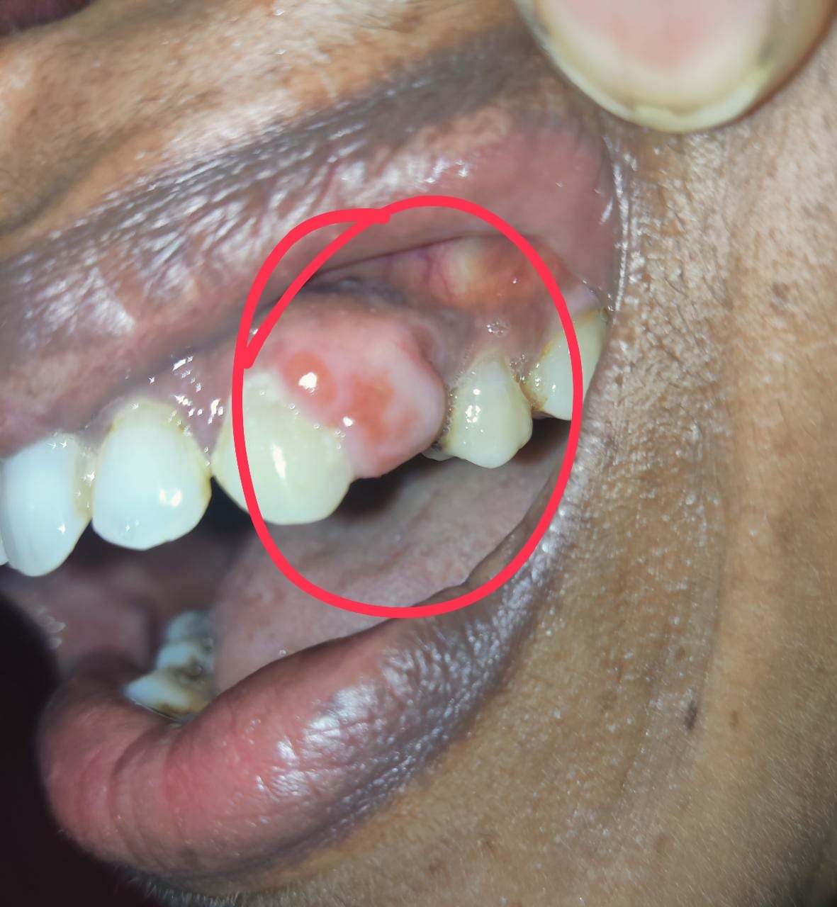 Hasan - Periapical abscess is pocket of pus around the tooth root. It ...