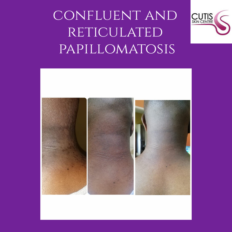 Confluent And Reticulated Papillomatosis – WNZCUJ