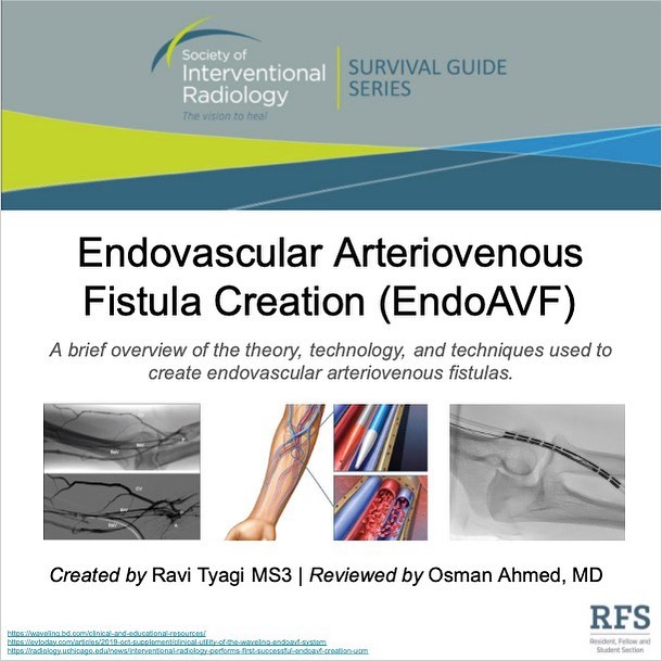 Endovascular arteriovenous fistula (endoAVF) creation is a novel ...