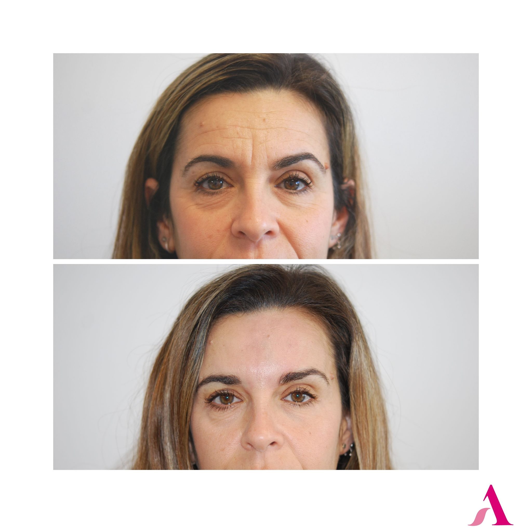 Clínica - El resultado de este tratamiento de botox es una muestra de ...