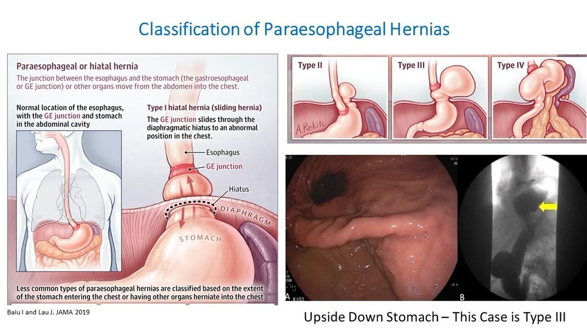 EndoCollab - Classification of Paraesophageal or Hiatal Hernias, With ...