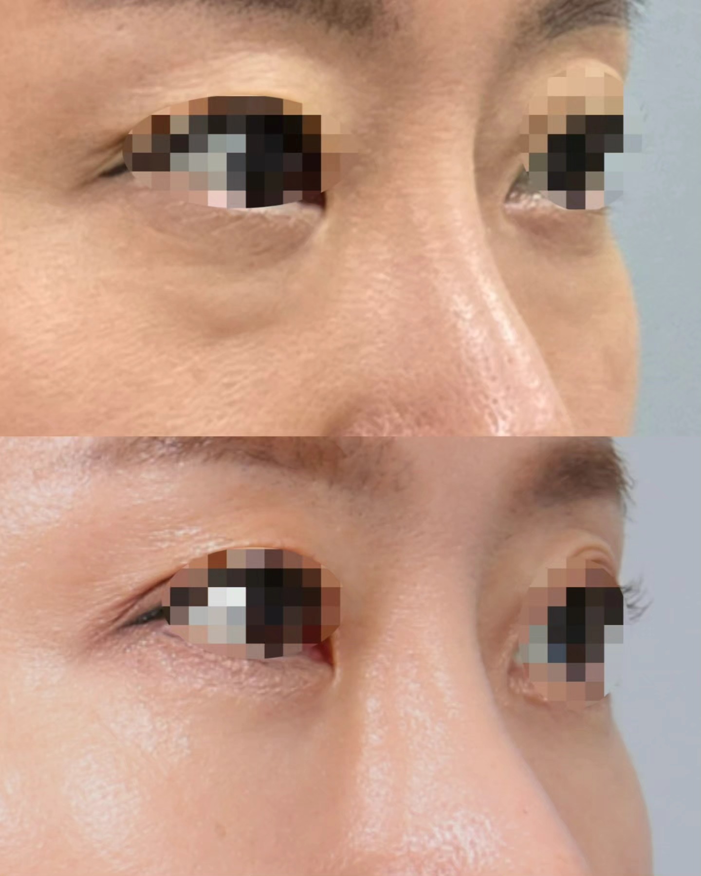 Min-Hee Ryu - [Dr. Ryu's Lower Blepharoplasty Case]: A... | Facebook