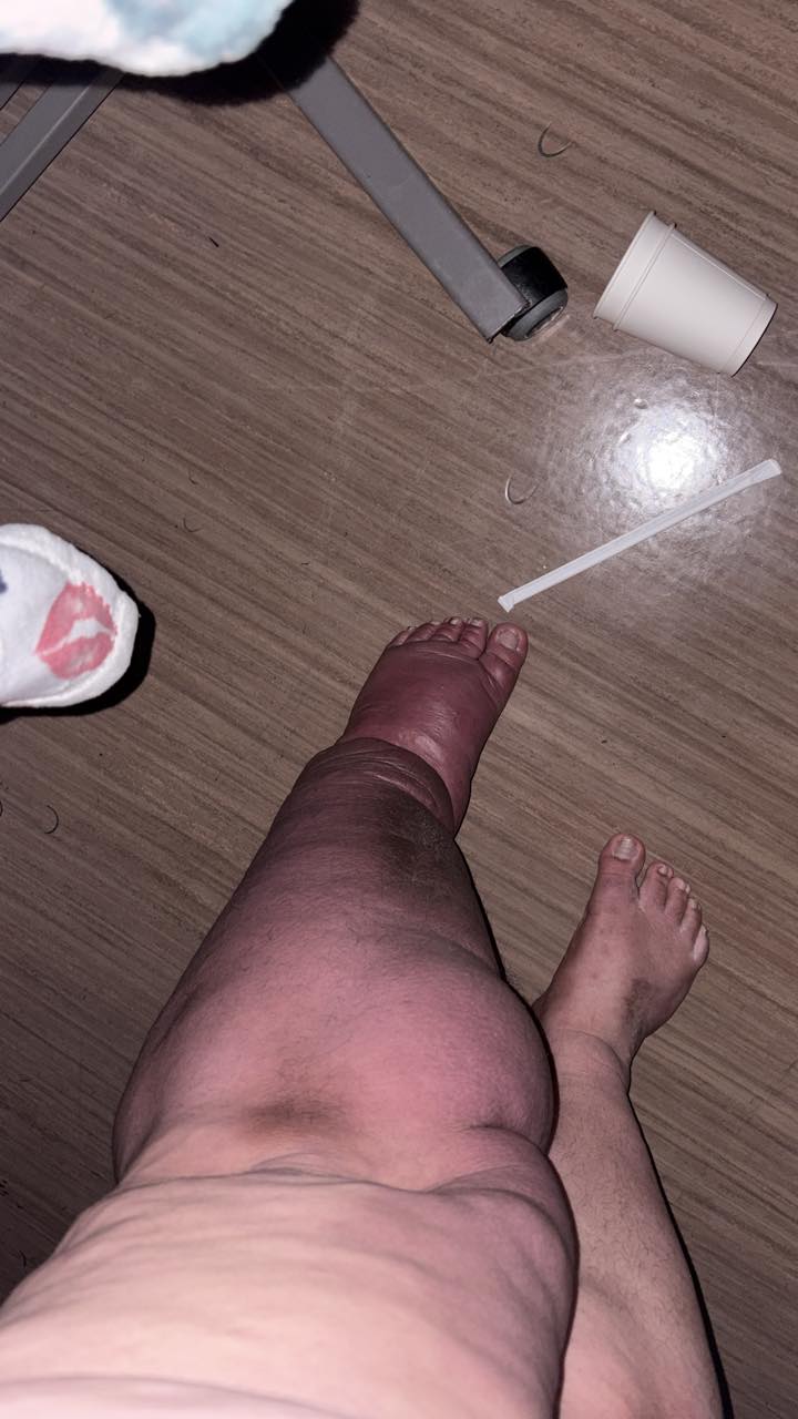 Experiences with tirzepatide for lymphedema?