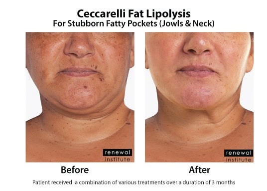 lipo-c injection side effects Lipotropic Injections for Weight Loss| Rivas Medical Weight Loss Lipo Shots (Lipotropic Injections): Do