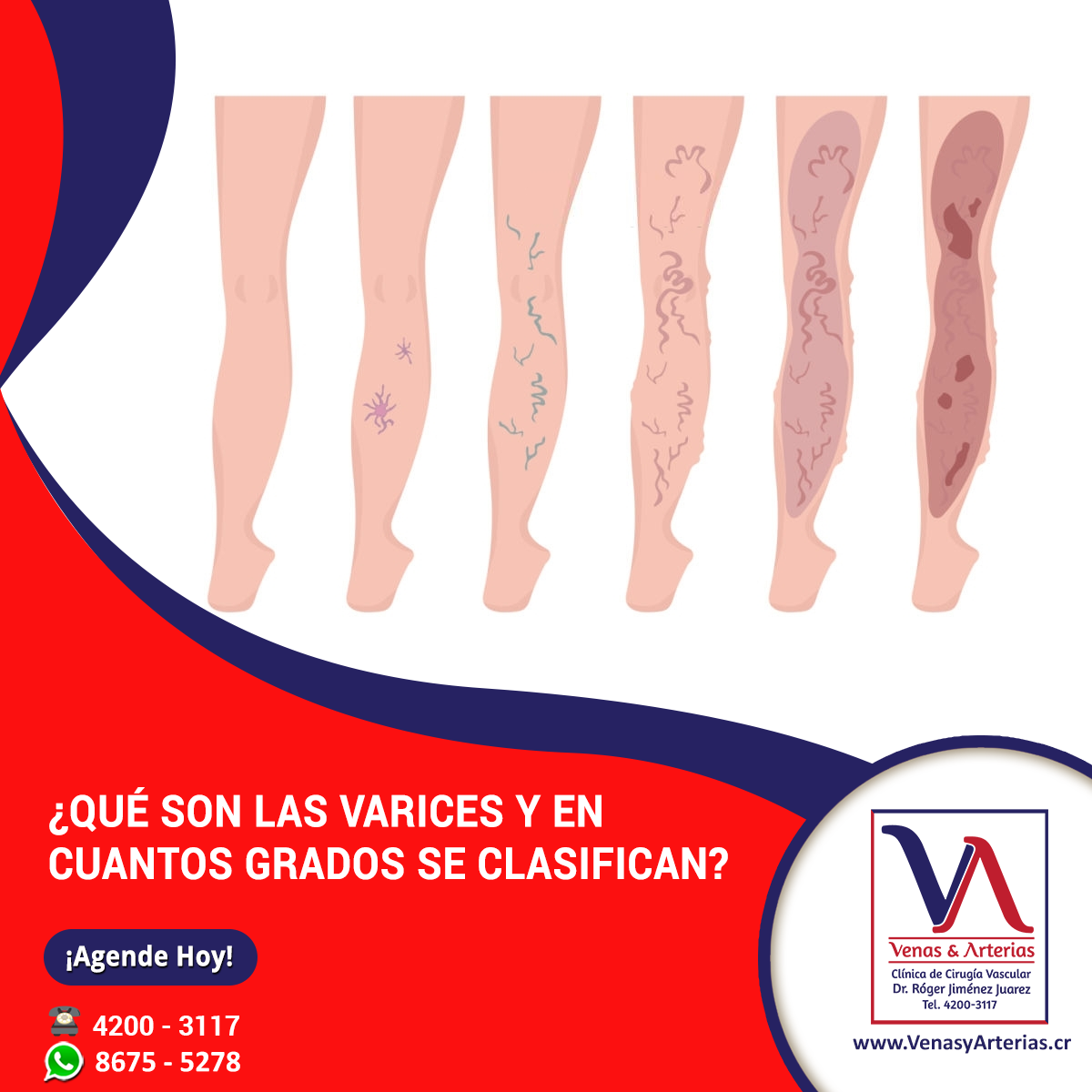 Clínica de Cirugía Vascular Venas & Arterias - 💁‍♀️ ¿Qué son las ...