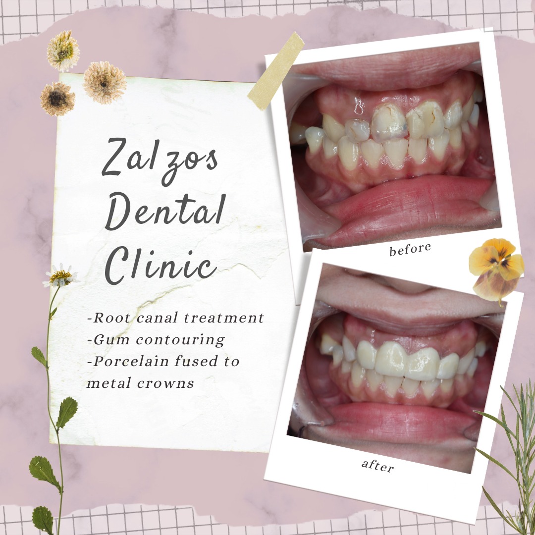 Case: Replacement of old and... - Zalzos Dental Clinic