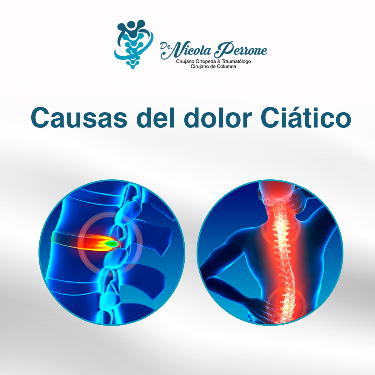 Dr. Nicola Perrone - Causas del dolor Ciático. La ciática ocurre cuando ...