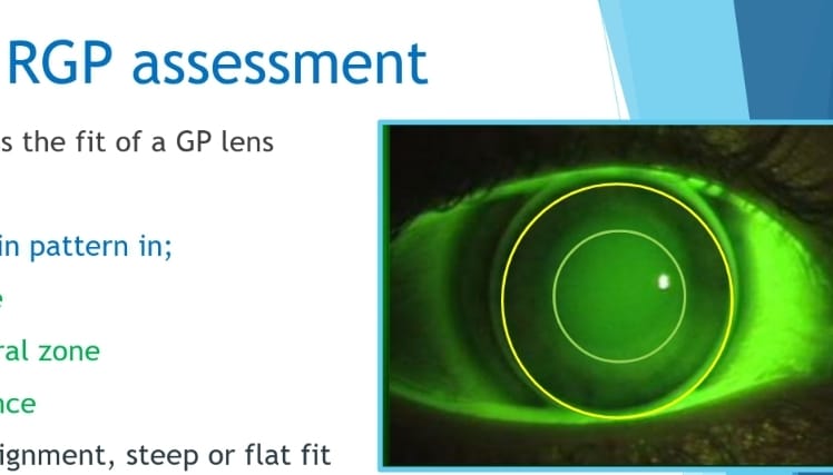 Optom Academy - This Sunday, a fantastic talk on RGP... | Facebook