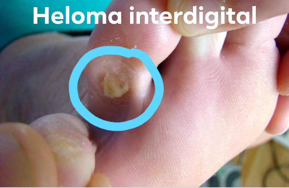 HELOMA... - Clínica Tándem Fisioterapia Y Podología