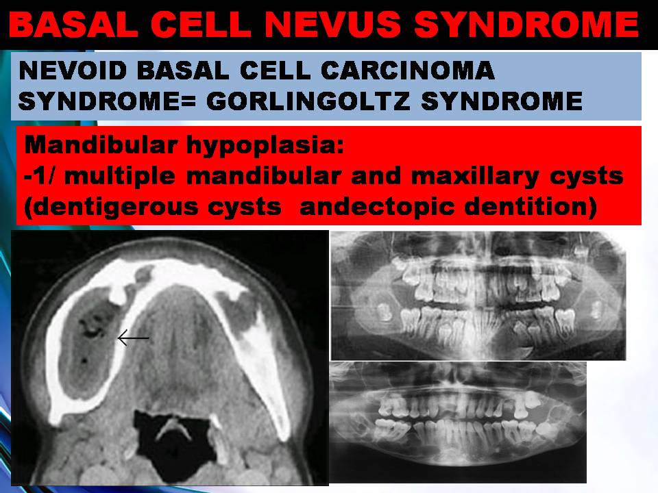 Basal Cell Nevus Syndrome Challenges And New Horizons In The
