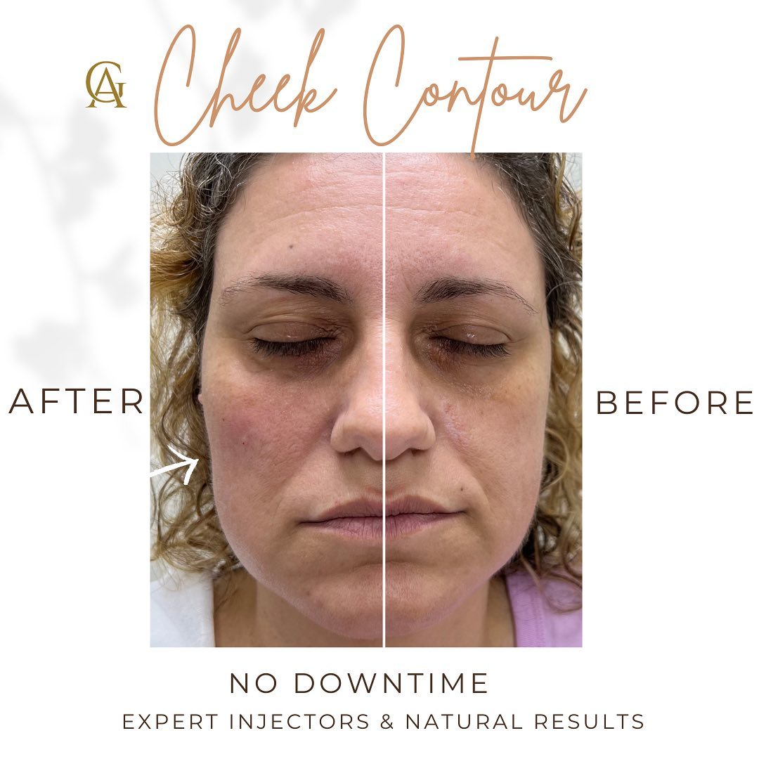 A subtle lift... - Goldfinger's Aesthetics & Plastic Surgery | Facebook