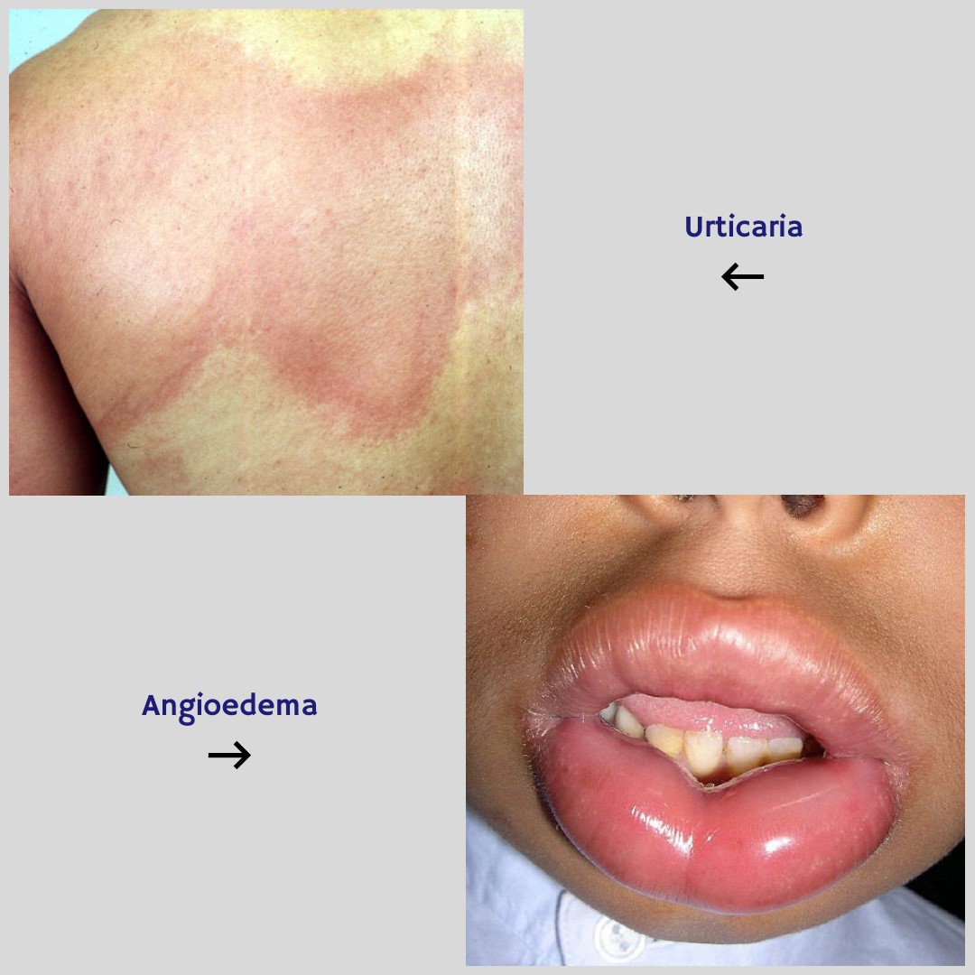 British Skin Foundation - What are urticaria and angioedema? Urticaria ...