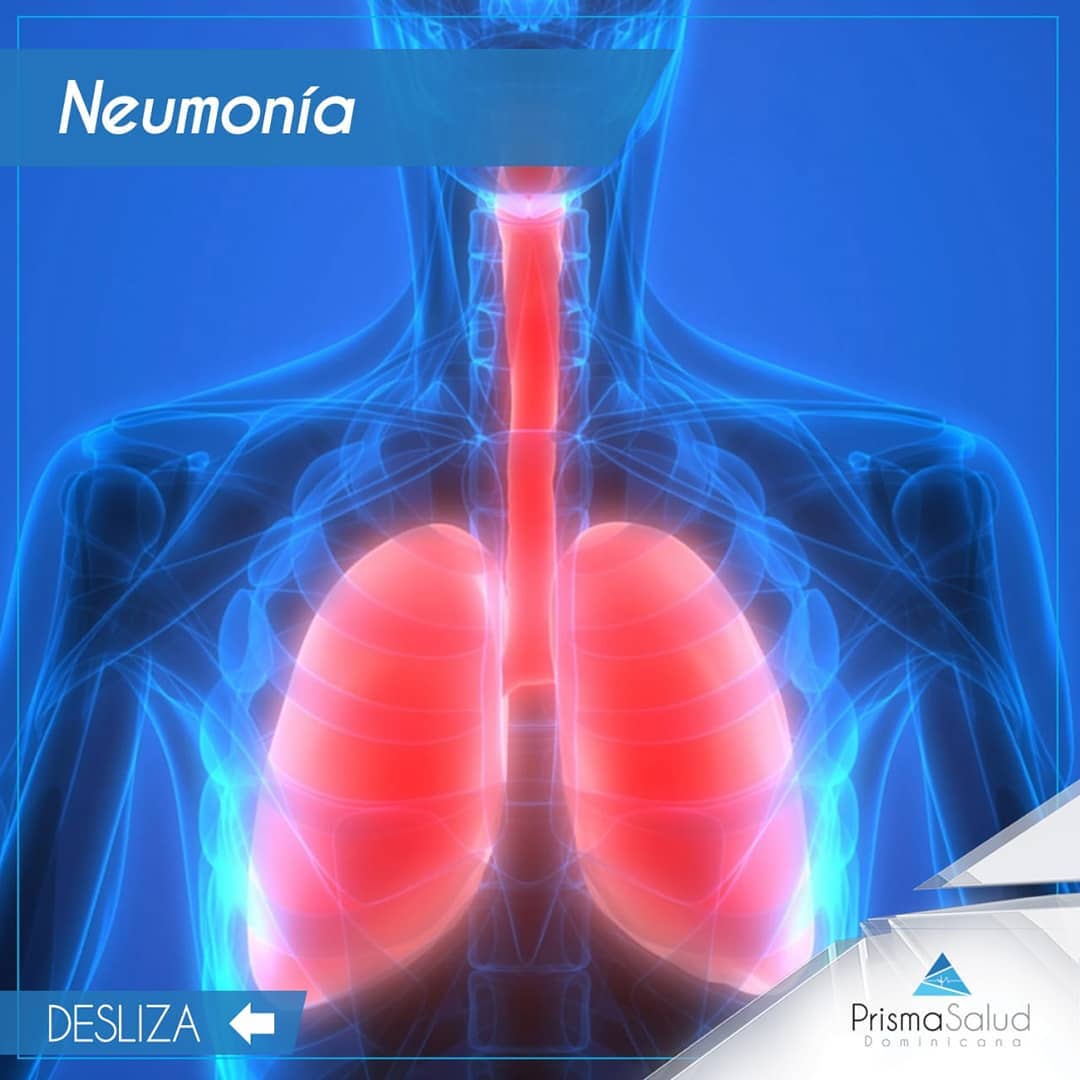 Prismasaludrd - La neumonía es una infección que inflama...