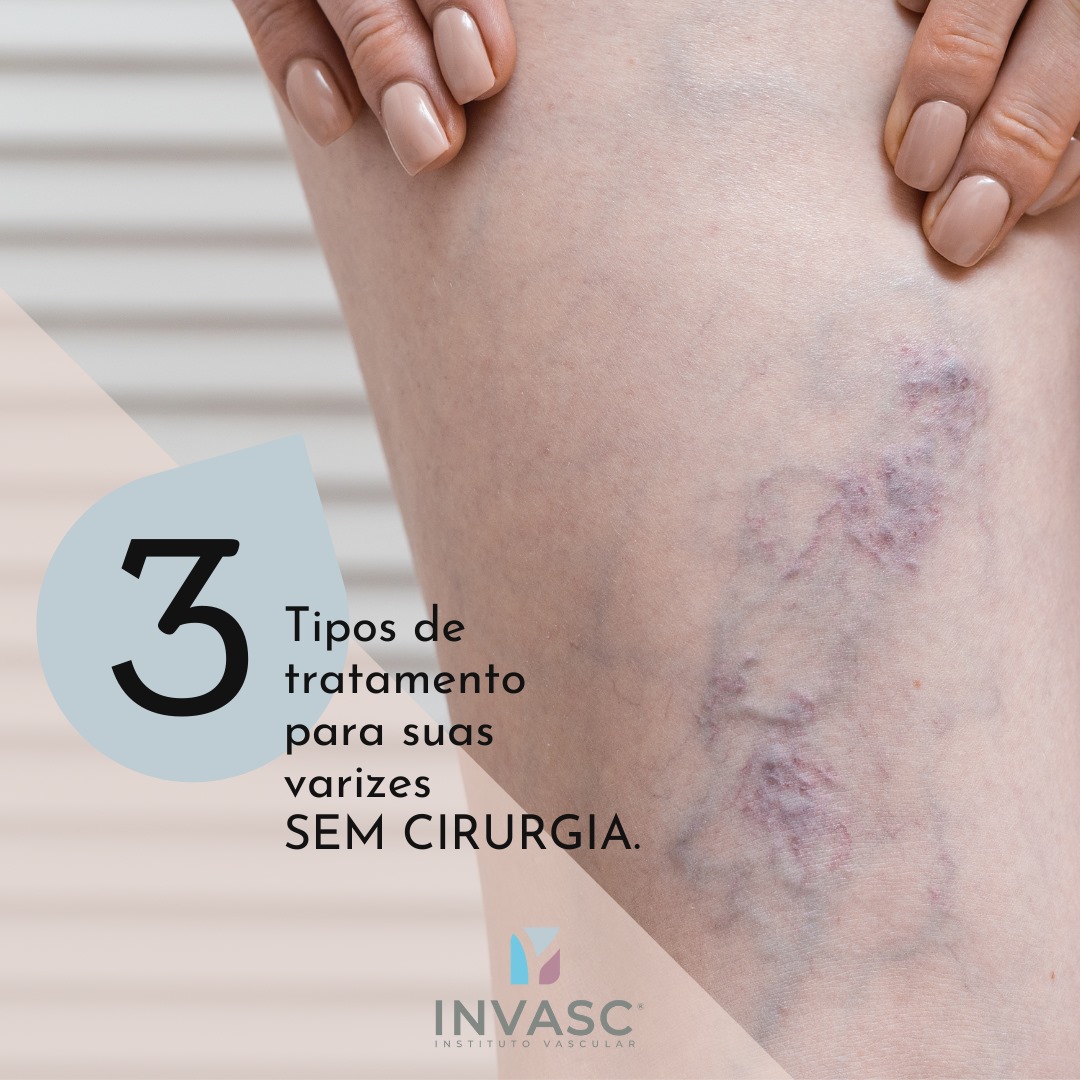 ☝️ 3 tipos de tratamento... - Invasc - Instituto Vascular | Facebook