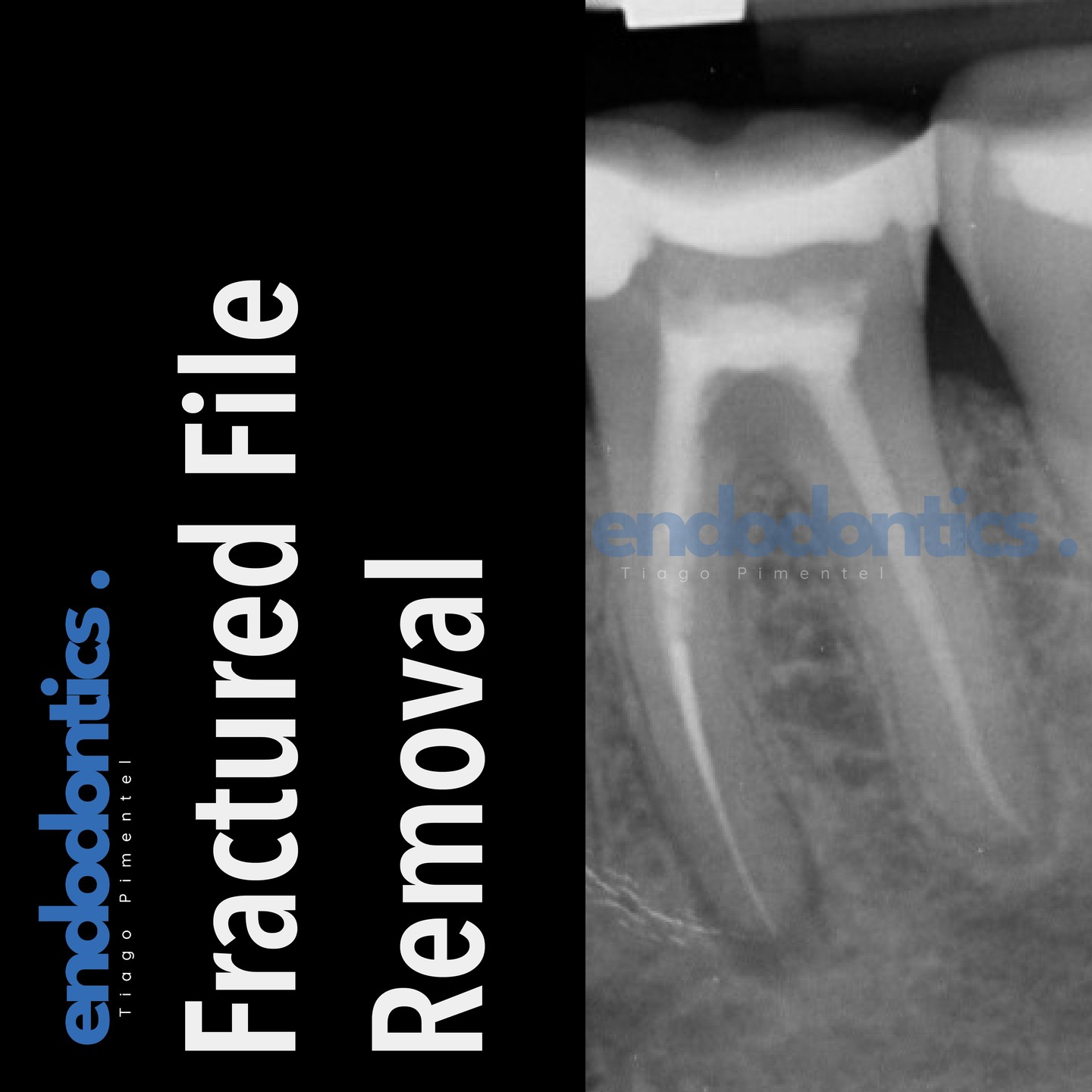 Tiago Pimentel - Endodontics