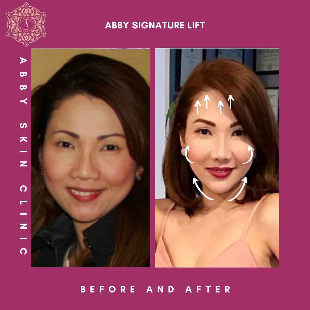 Abby