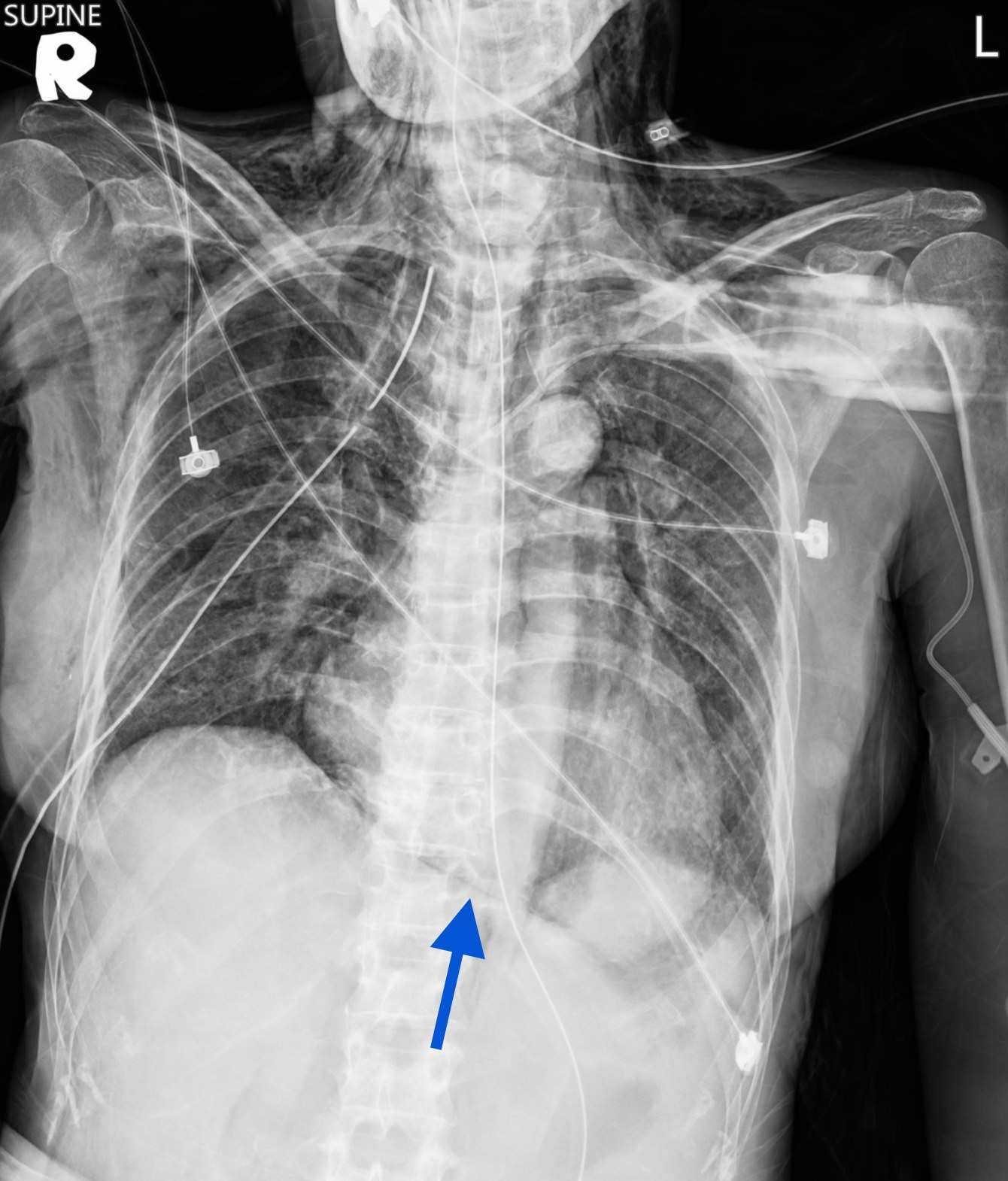 Radiographic signs, No. 1 Pneumomediastinum - continuous diaphragm sign ...