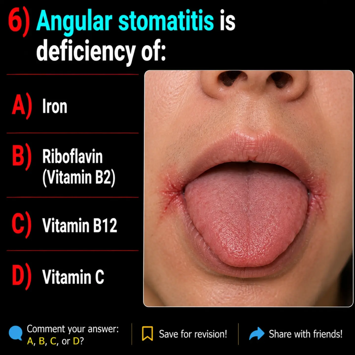 vitamin c deficiency lips Causes of Angular stomatitis ✓ Contents:60 tablets
