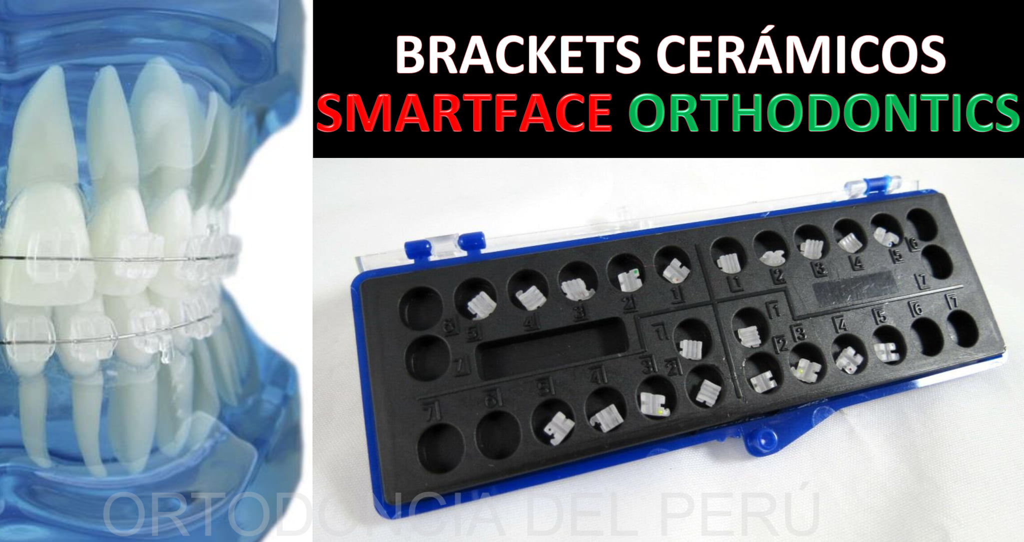 👍😉BRACKETS CERÁMICOS ROTH Y MBT !!!!... - Ortodoncia del Perú | Facebook