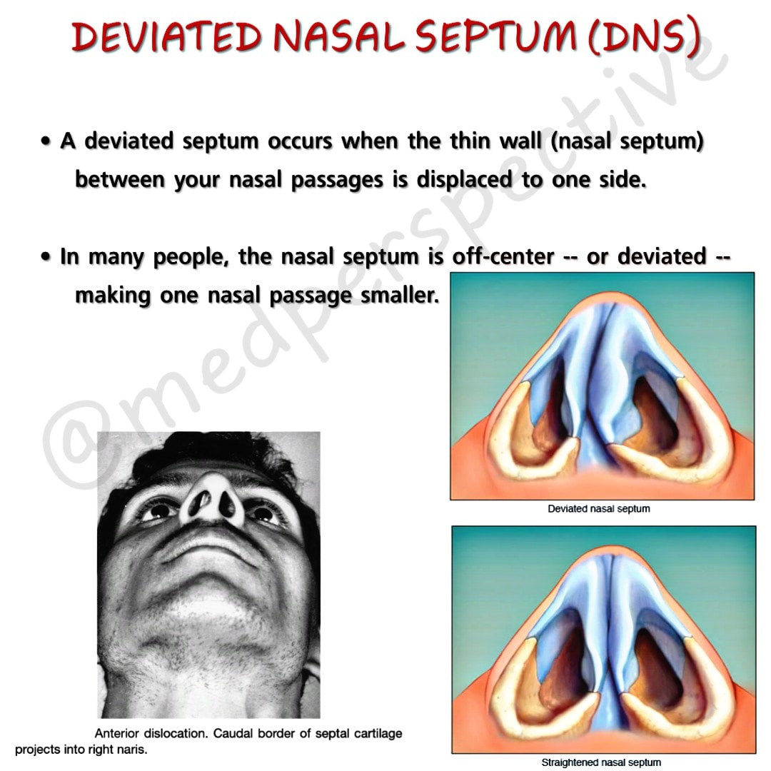 Med Perspective - Deviated nasal septum #MedPerspective...