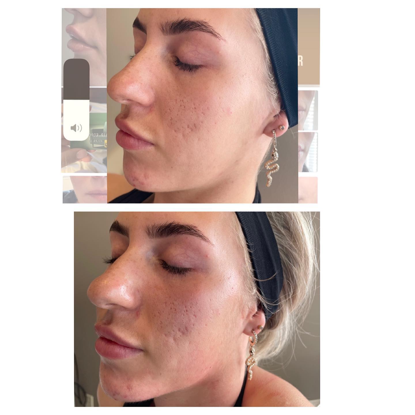 nv_derma - Treatment : Facial Threads 💉 A thread lift is... | Facebook