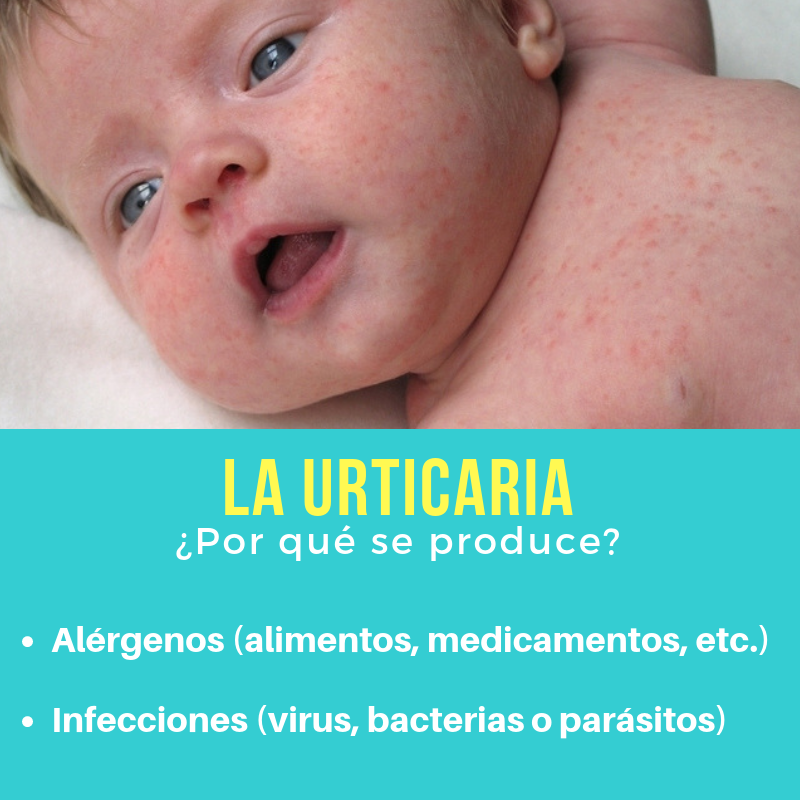 Dr. - ️La Urticaria , se caracteriza por la aparición en la piel de ...
