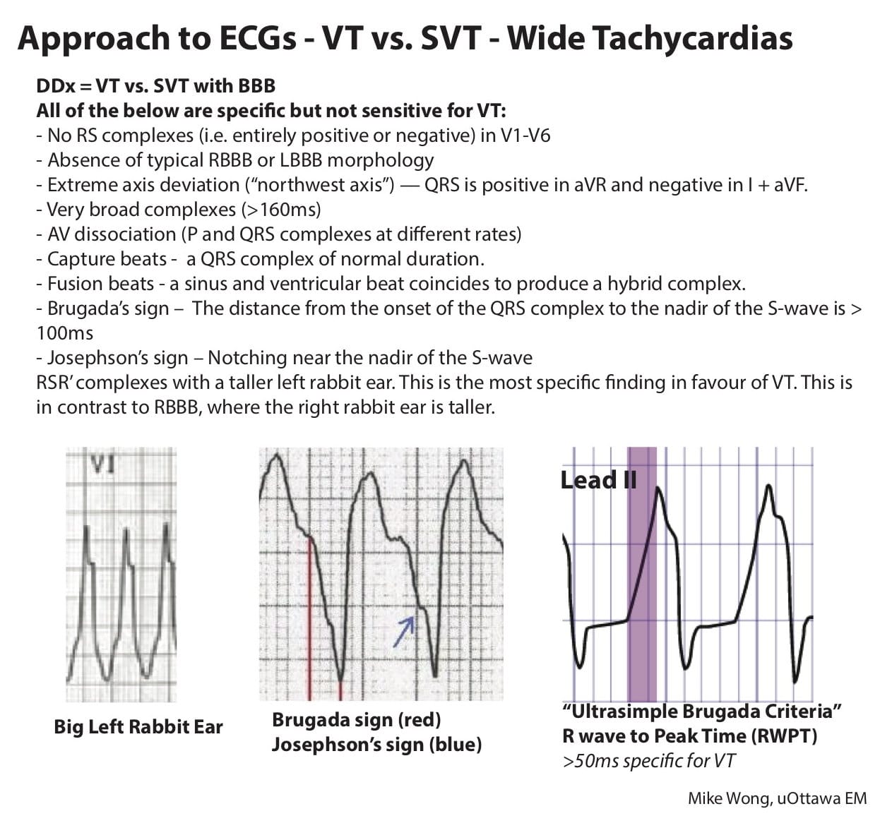Critical Care Recent Guidelines(CCRG) | #Approach to ECGs - VT vs ...