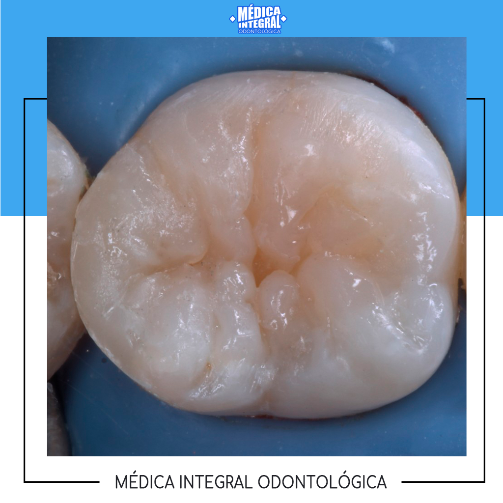¿Percibes la resina?... - Médica Integral Odontológica