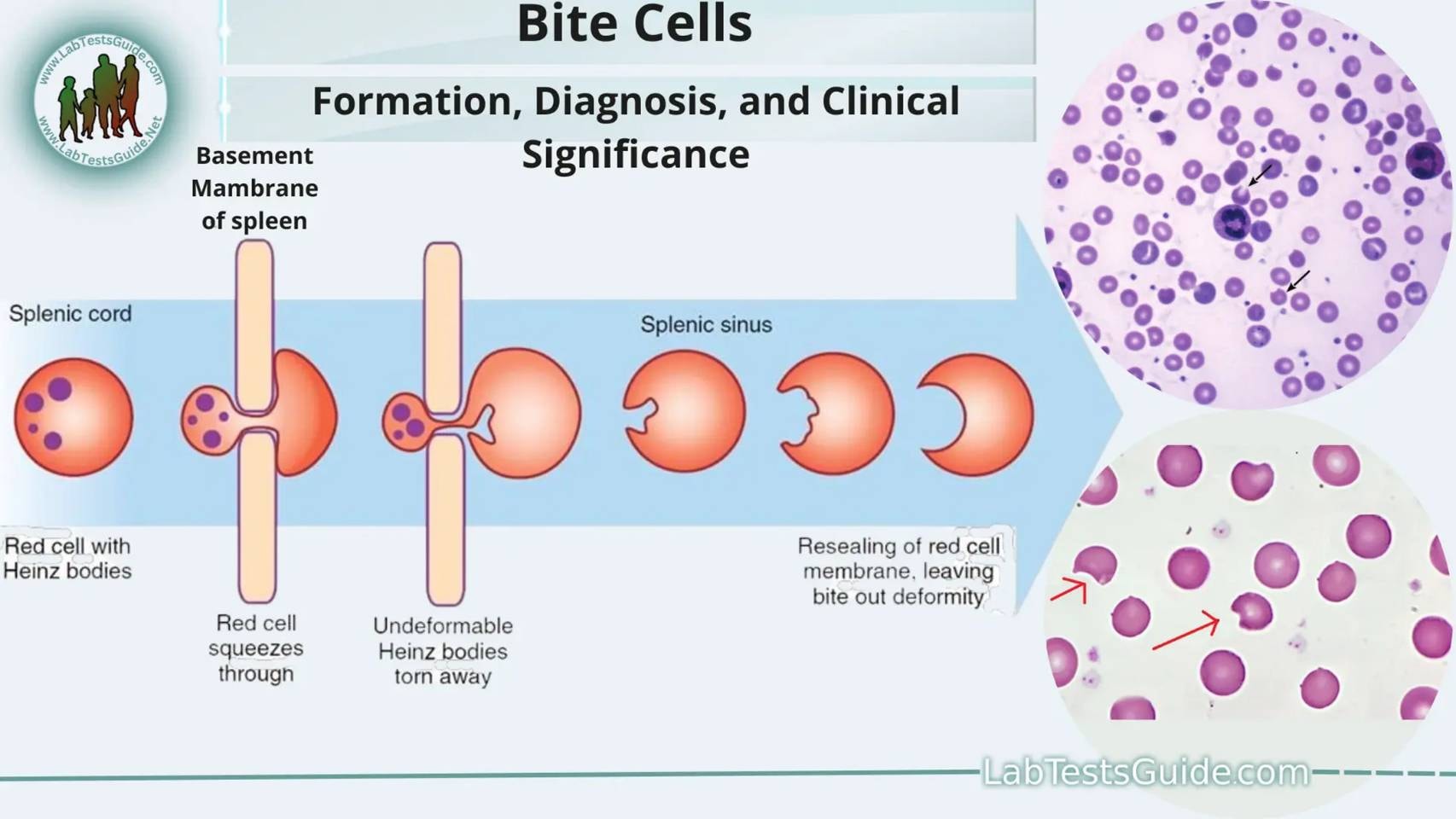 glutathione reductase deficiency bite cells ✴️ and Blister Cells in the Diagnosis of G6PD Deficiency✴️ Bite cells and blister cells are important morphological findings on peripheral blood smears, especially during hemolytic episodes. Their presence serves Nutritional Supplement
