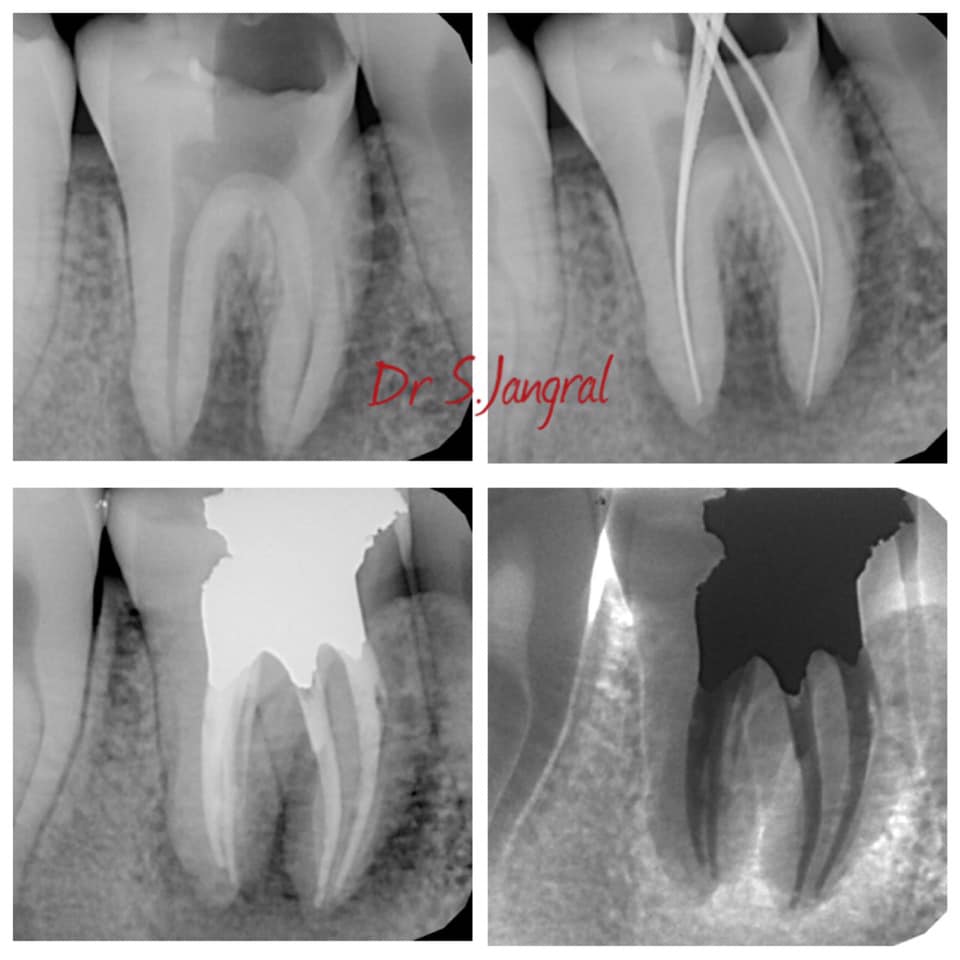 Routine RCT treatment on lower... - Oracare Dental clinic