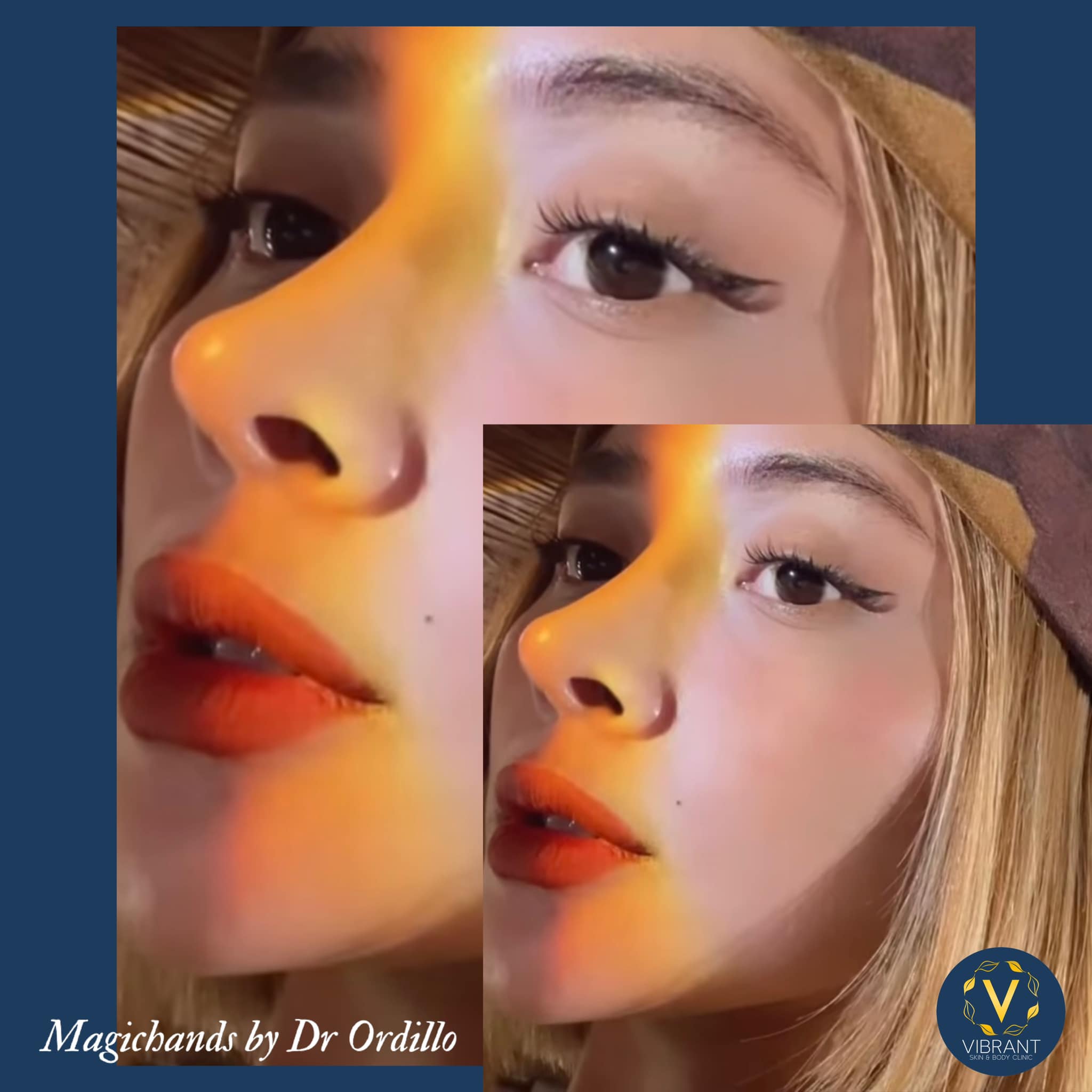 NOSE UPDATE!... - Vibrant Skin & Body Clinic by Dr. Ordillo