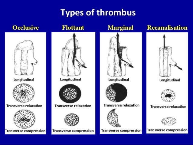 Types of thrombus - Cardiology and CCU | Facebook