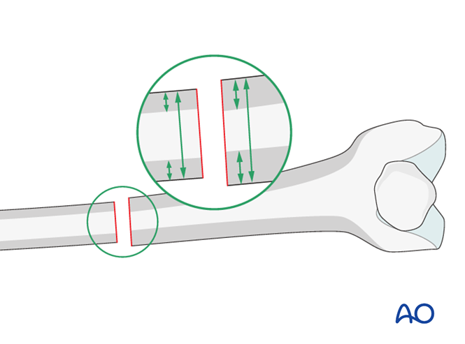 OrthoMan Page - Cortical step sign and diameter difference sign The ...